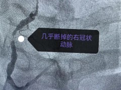抗疫工作人员突发心肌梗死，新华医院医生穿防护服为其手术